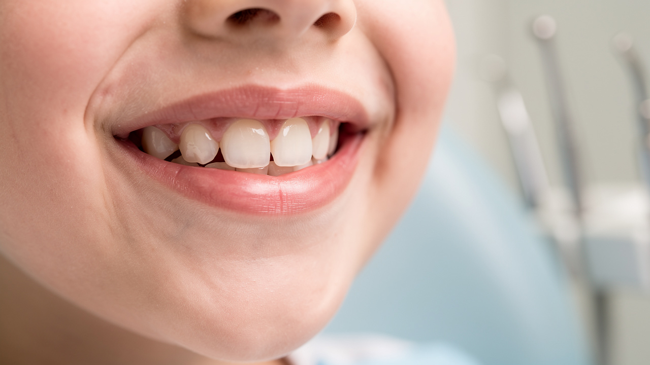 4-steps-to-understand-shaved-teeth-after-braces-for-parents