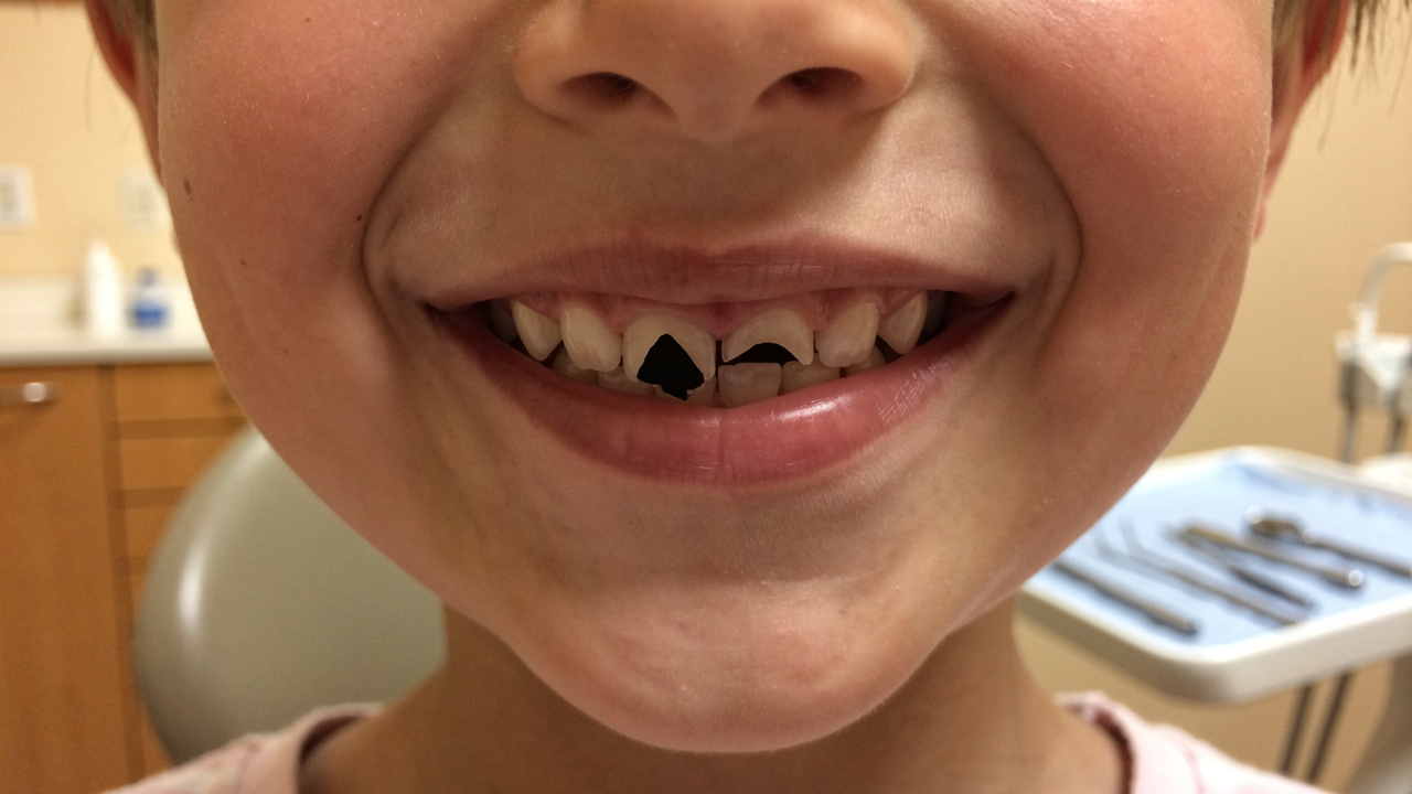 understanding-black-triangles-after-braces-causes-and-solutions